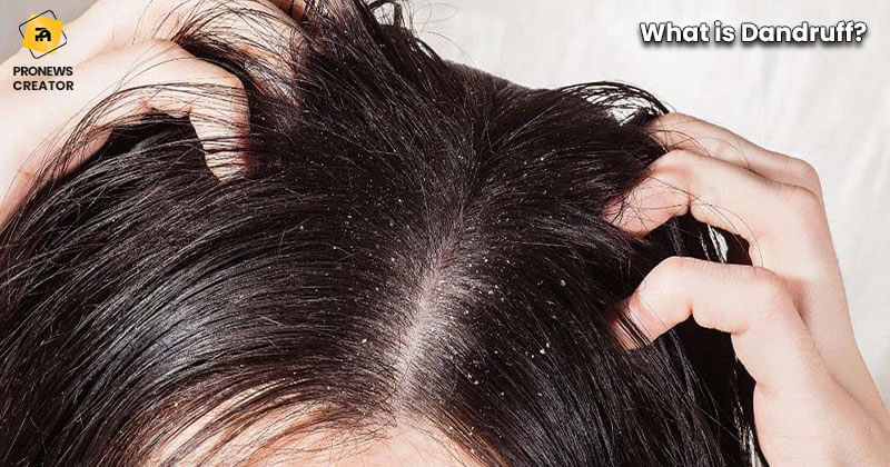 What is Dandruff